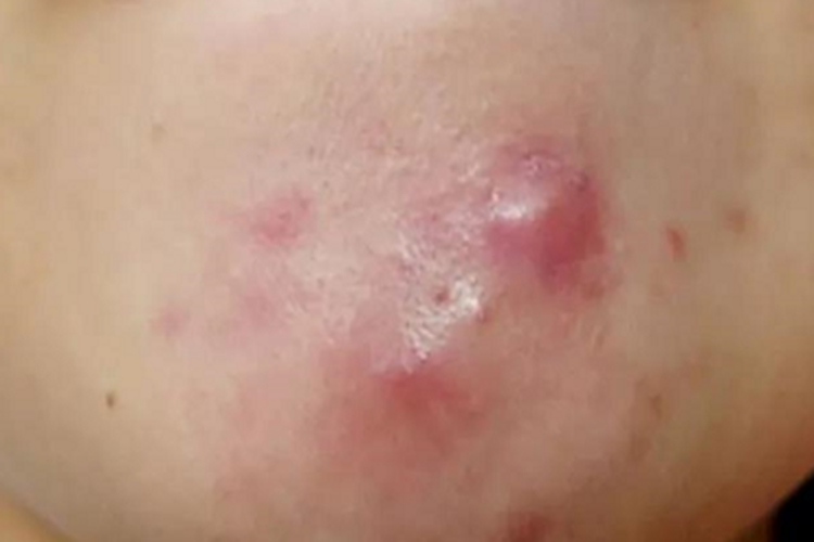 下巴颏下面痤疮硬疙瘩图