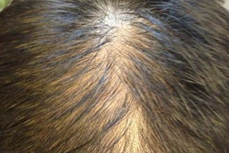 少毛症头顶大量脱发图 少毛症头顶大量脱发图