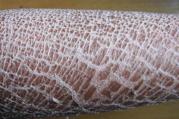 板层状鱼鳞病图