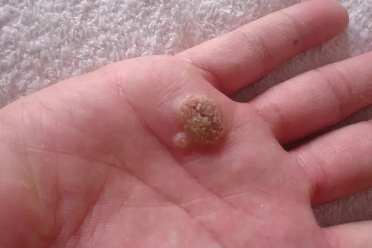 艾滋病寻常疣图 艾滋病寻常疣图