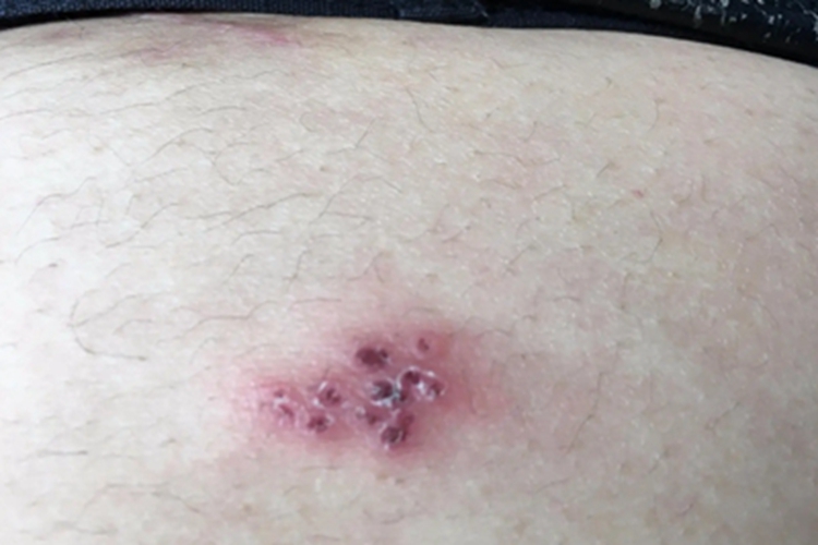 淋巴瘤样丘疹病腹部结痂图