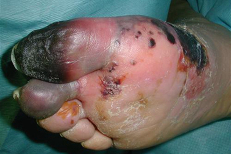 坏疽脚趾红肿图