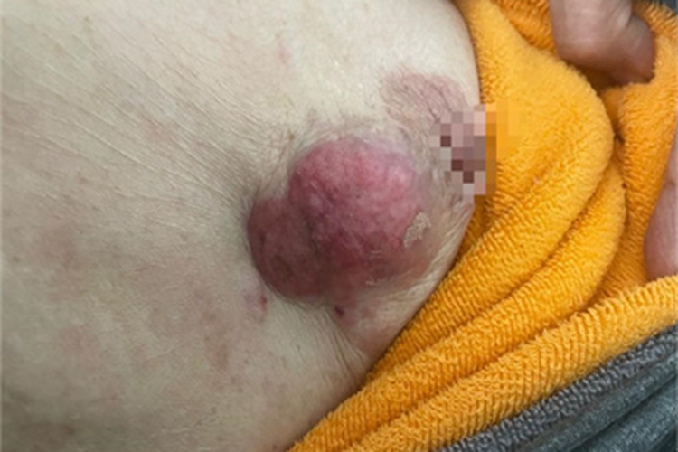 乳腺癌乳房硬块图