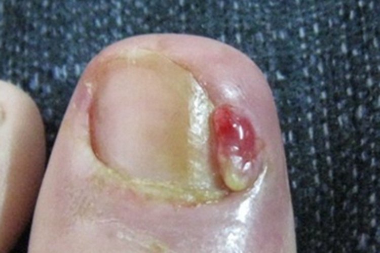 甲床炎脚趾红肿化脓图 甲床炎脚趾红肿化脓图