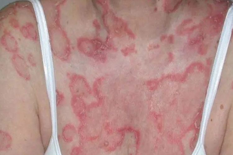 早期的丘疹鳞屑型红斑狼疮图