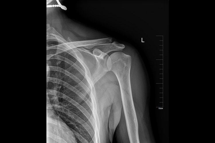 肱骨正侧位标准片图