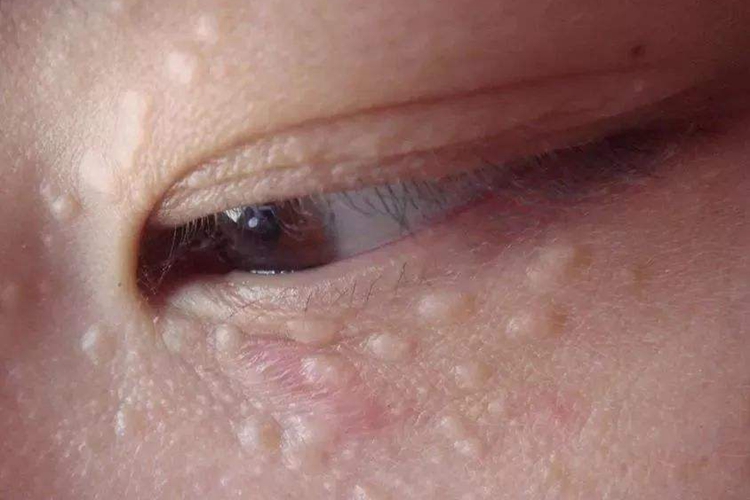 眼袋上的扁平疣图 眼袋上的扁平疣图