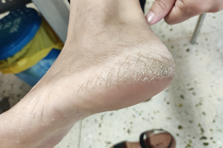 Ⅱ度皮肤皲裂脱皮图