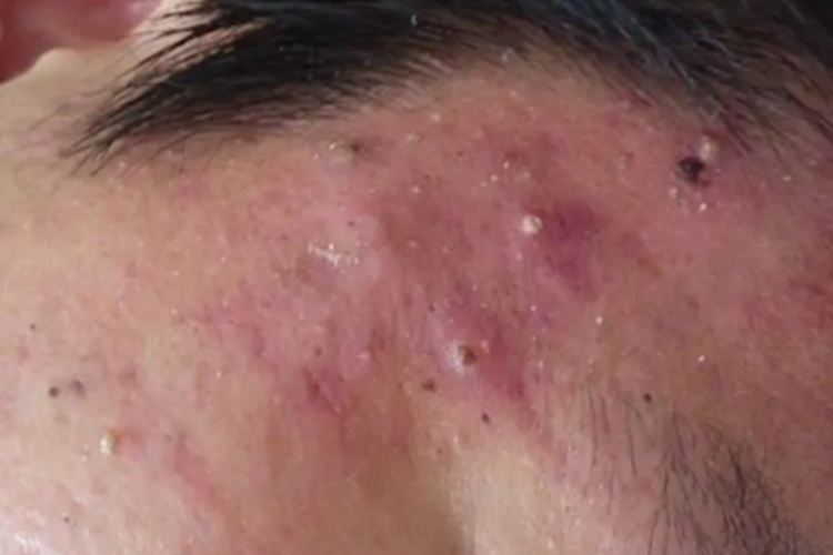 暴发性痤疮颞部症状图 暴发性痤疮颞部症状图