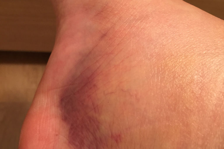 外伤软组织发炎肿胀图