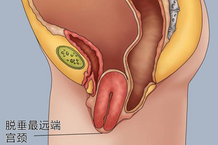 子宫脱垂示意图