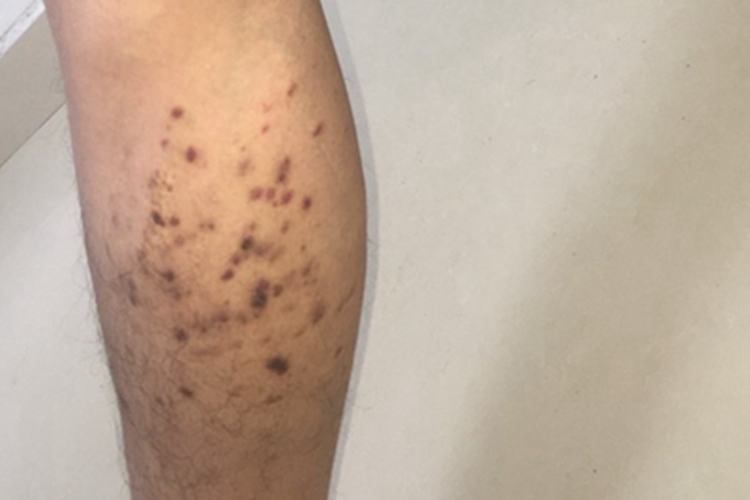 卡波西肉瘤小腿症状图 卡波西肉瘤小腿症状图