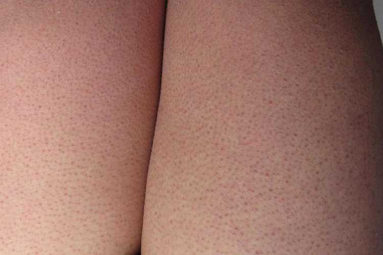 毛周角化症小米粒疙瘩图