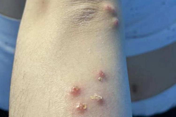 丘疹性荨麻疹结痂图