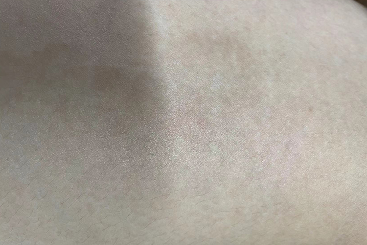 体癣皮肤恢复正常图