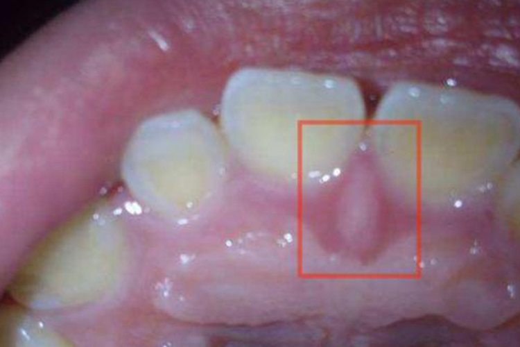 上颚切牙乳头图