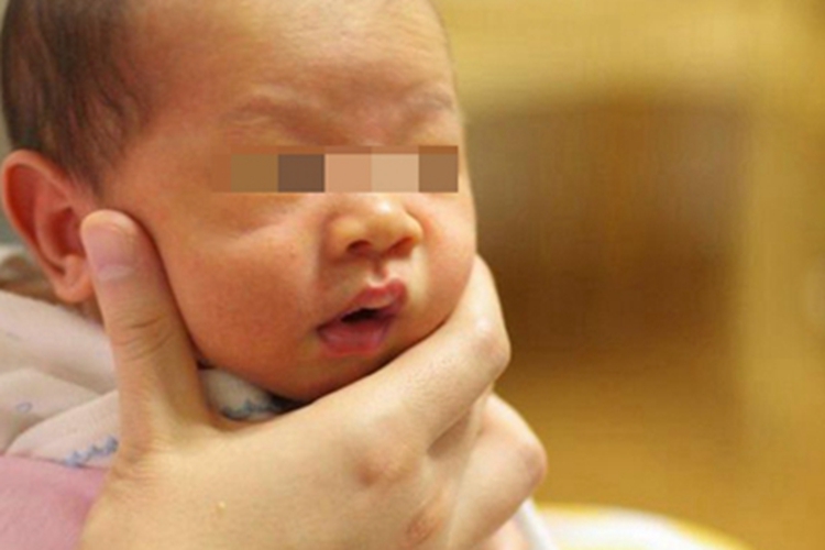 Rotor综合征面部皮肤发黄图