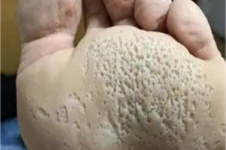 窝状角质松解症脚底有密集小坑图 窝状角质松解症脚底有密集小坑图