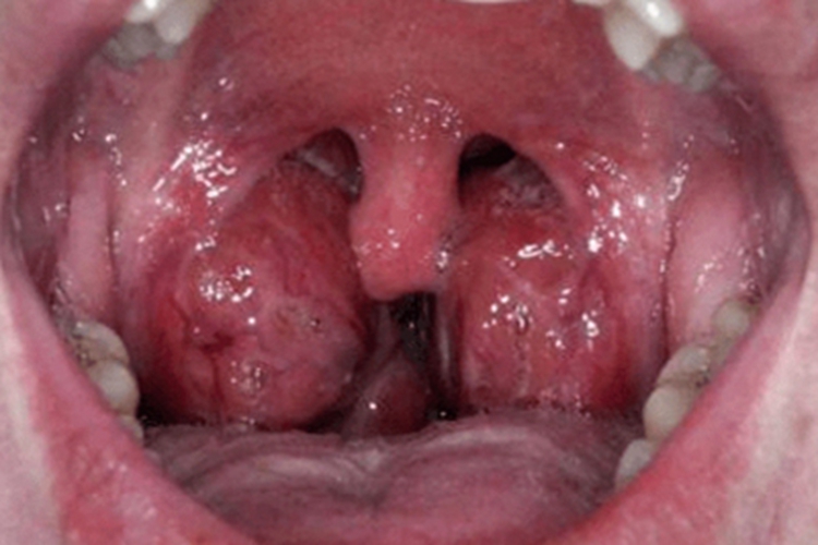 急性化脓性扁桃体炎充血图