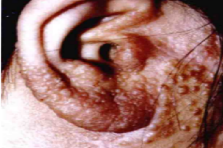 无绿藻病耳部症状图