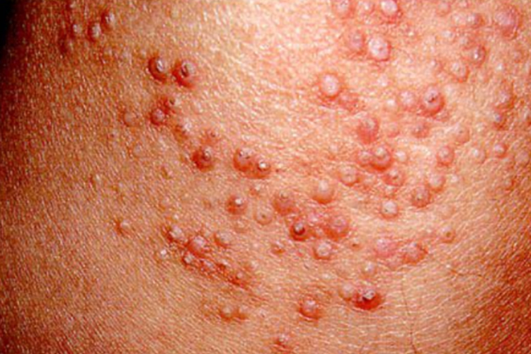 穿透型环状肉芽肿症状图