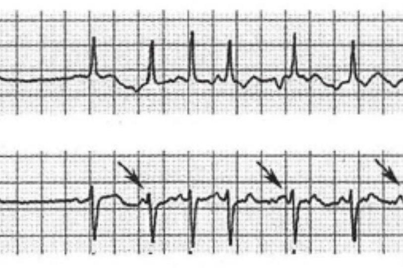 源性房性心动过速图 源性房性心动过速图