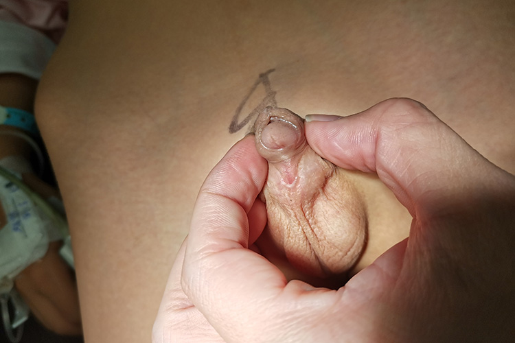 阴茎阴囊型的尿道下裂症状图