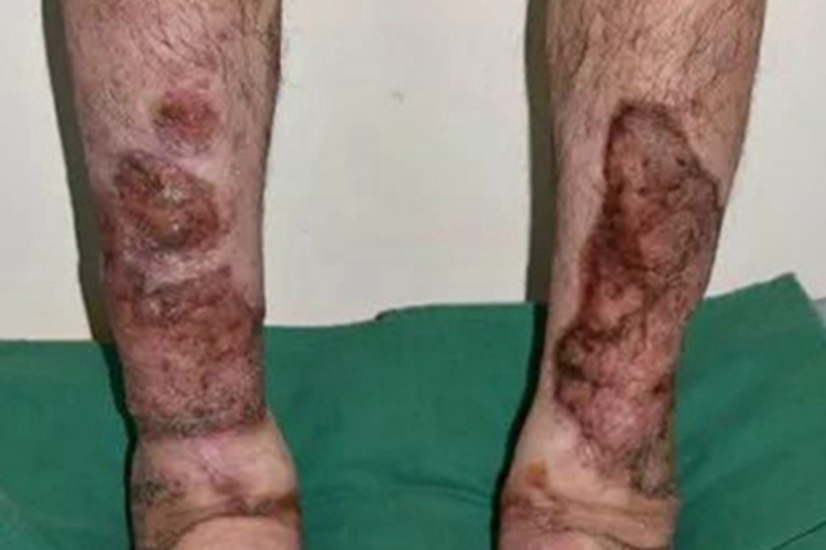 胫前黏液性水肿小腿红褐色斑片图 胫前黏液性水肿小腿红褐色斑片图