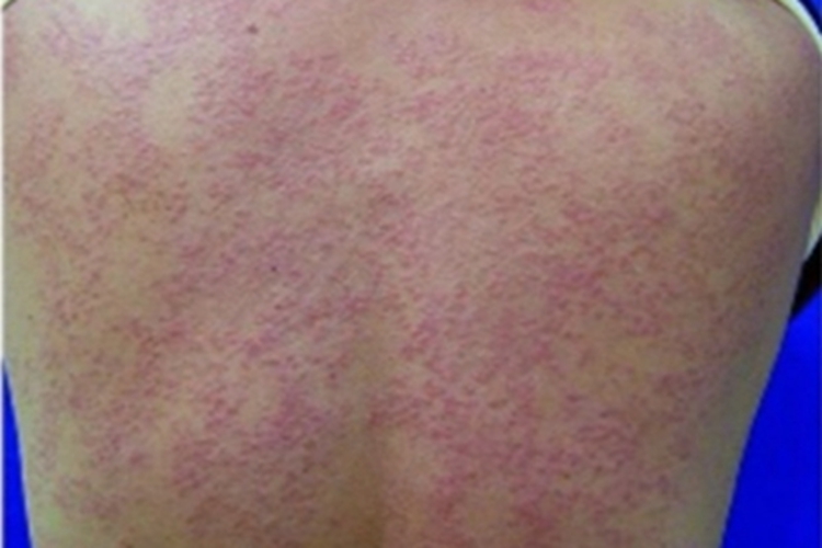 环状肉芽肿背部丘疹图 环状肉芽肿背部丘疹图