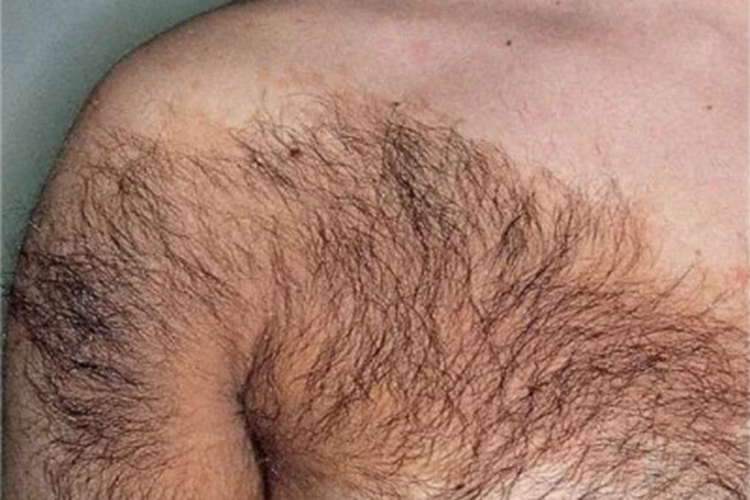 色素性毛表皮痣胸部症状图