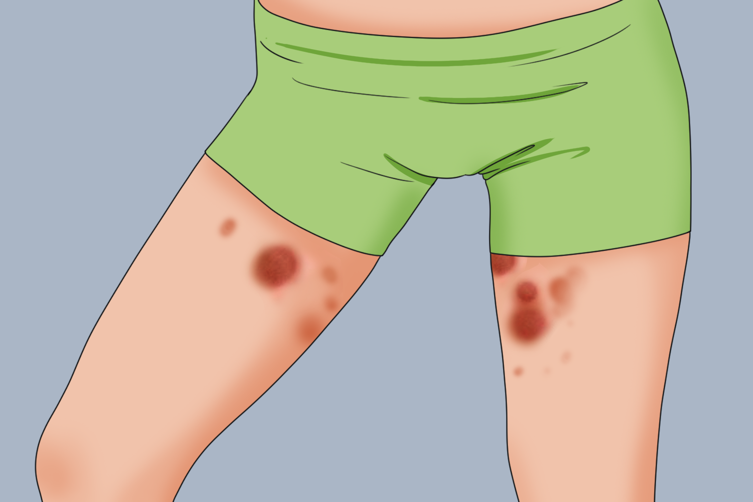 大腿内侧红癣图
