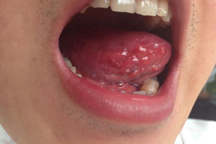 口腔尖锐湿疣舌头疙瘩图 口腔尖锐湿疣舌头疙瘩图