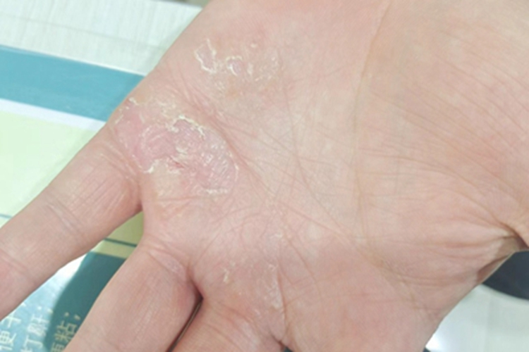 掌跖脓疱病手掌心脱皮图