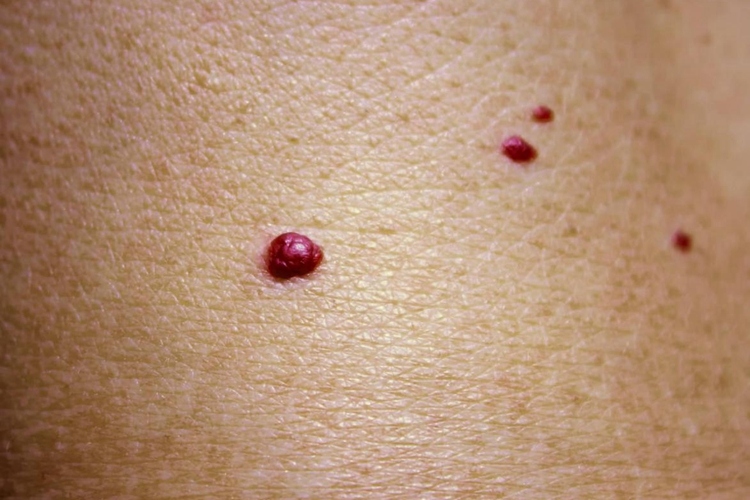 肺癌身上起红点图