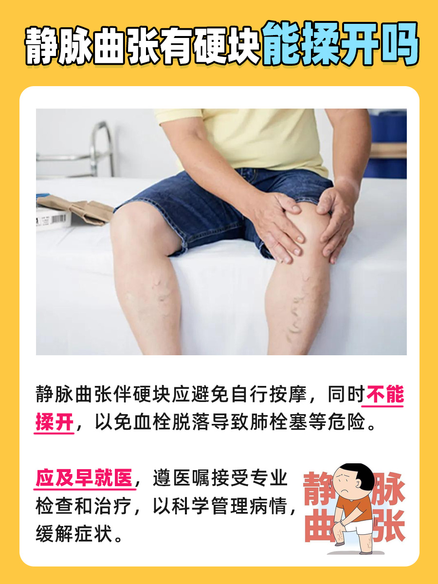 静脉曲张伴有硬块，自行按摩能揉开吗