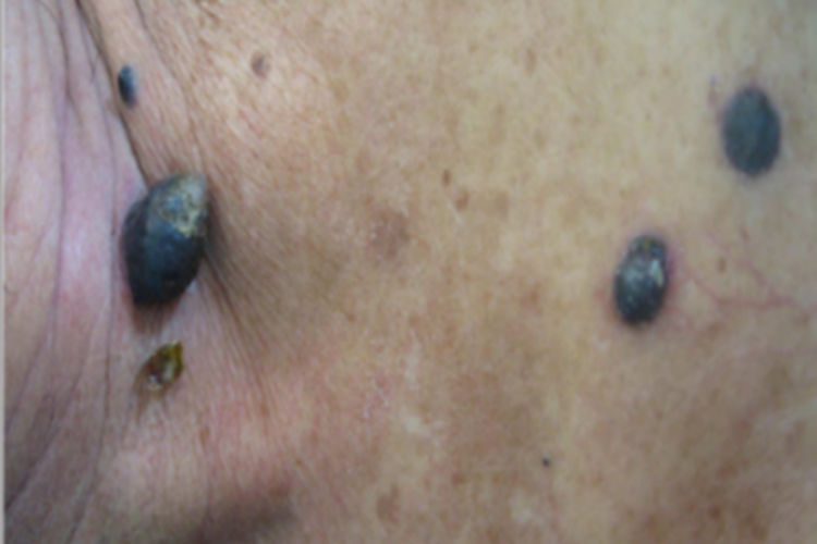 结节型黑色素瘤胸部症状图