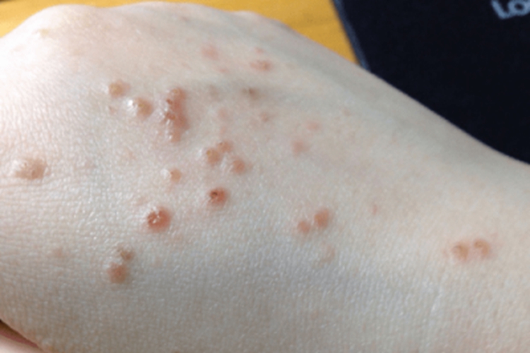 疱疹样湿疹手背小水疱图 疱疹样湿疹手背小水疱图