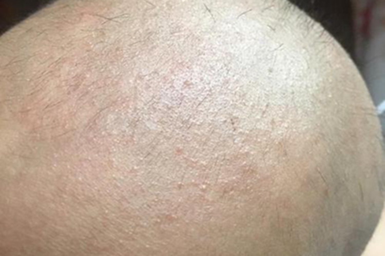 少毛症头发非常稀少图