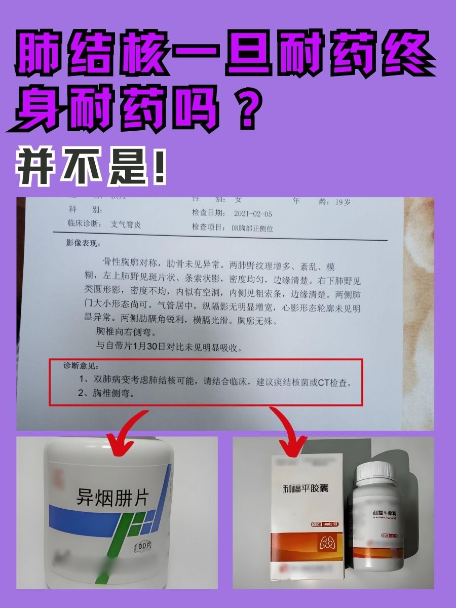 肺结核一旦耐药终身耐药吗？并不是！