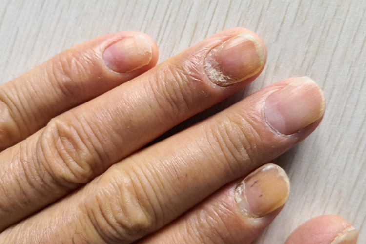 甲癣指甲缝里白色硬皮图 甲癣指甲缝里白色硬皮图