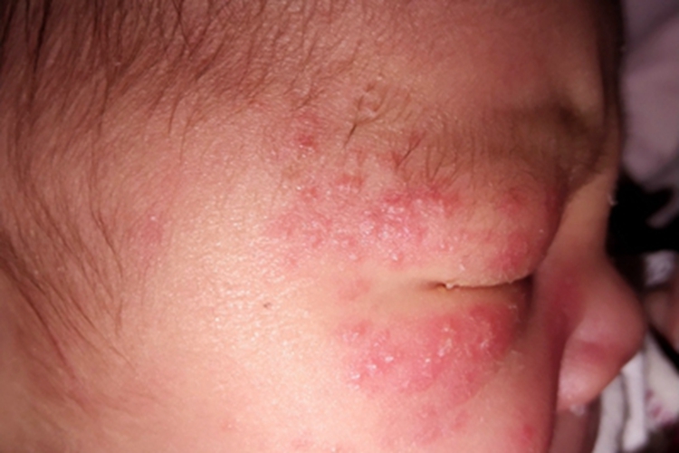 新生儿痤疮红斑图