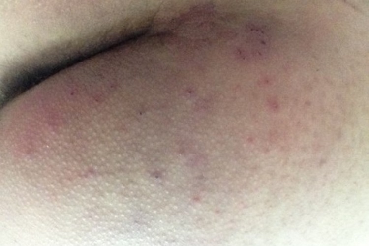 聚合性痤疮臀部红肿图 聚合性痤疮臀部红肿图