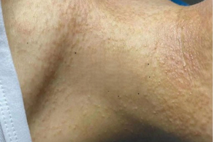 汗管瘤侧颈密集褐色疙瘩图