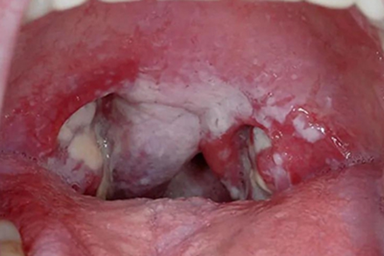 鹅口疮咽喉白斑图