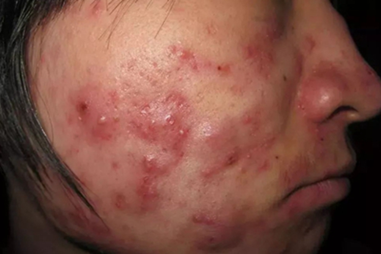 隐球菌病结节图 隐球菌病结节图