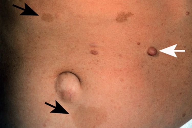 皮肤神经纤维瘤图 皮肤神经纤维瘤图