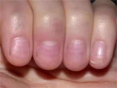 急性铊中毒指甲上有几条白色的横纹图.jpeg