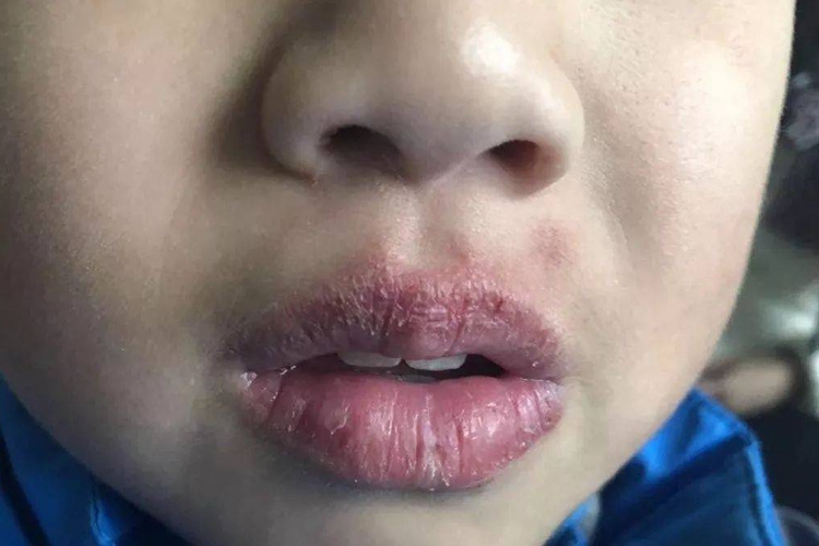 小孩咬嘴唇出现皲裂图
