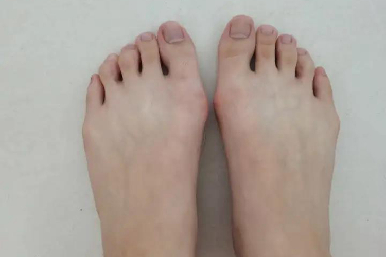 拇外翻15度图 拇外翻15度图