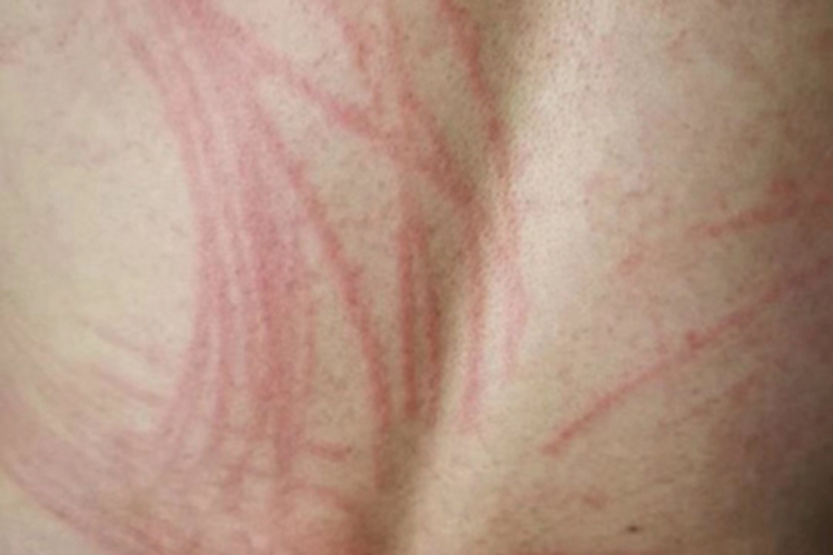 人工荨麻疹红斑图 人工荨麻疹红斑图